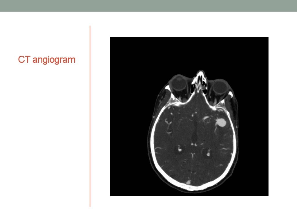 CT angiogram